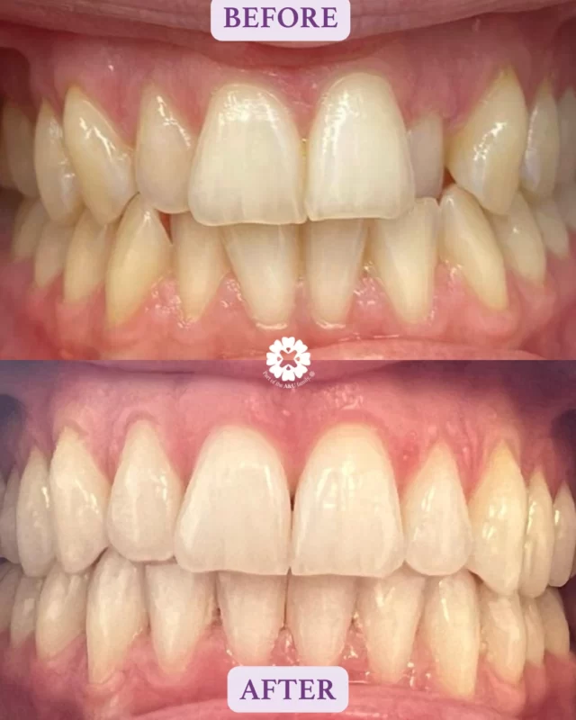 ✨ Spark Aligners Transformation in Just 20 Weeks! ✨

Check out this stunning smile makeover using Spark Aligners, beautifully completed by Dr. Dimitra Markopoulou.
In just under 5 months, we achieved a straighter, more confident smile — with barely visible aligners!

Thinking about clear aligners? Let us show you what’s possible.
📍 Book your free consultation today - 📞 Call us at 01942 676336 or book online https://audental.co.uk/avenue-dental-centre

#Aligners #AvenueDentalCentre #Leigh #DentalBraces #Orthodontist