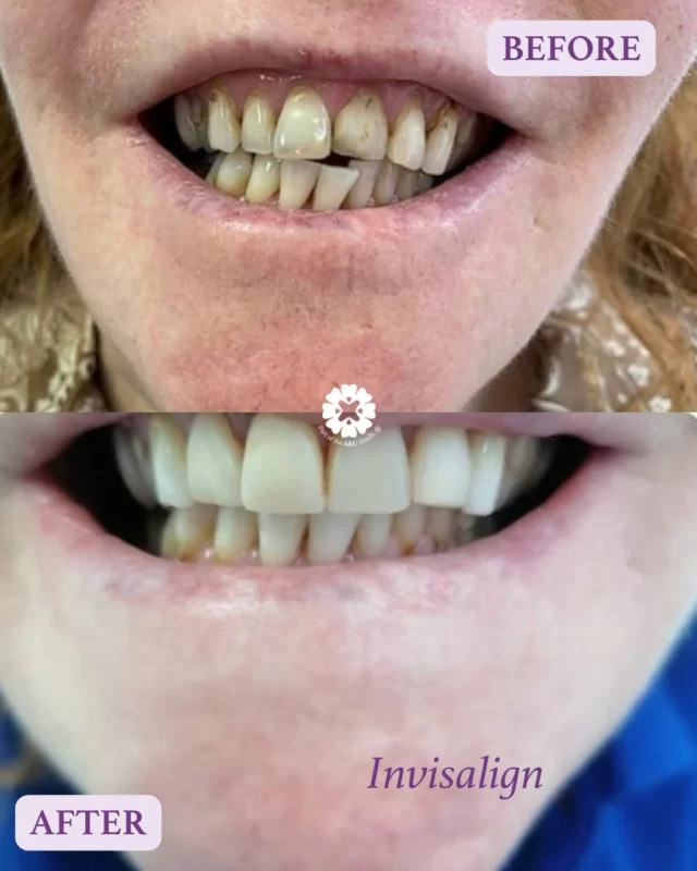 Before ➡️ After — A confident new smile, crafted by Dr. Rabia with Composite Bonding!
#Invisalign #ClearAligners #BeforeandAfter #AvenueDentalCentre #Leigh #DentalPractice