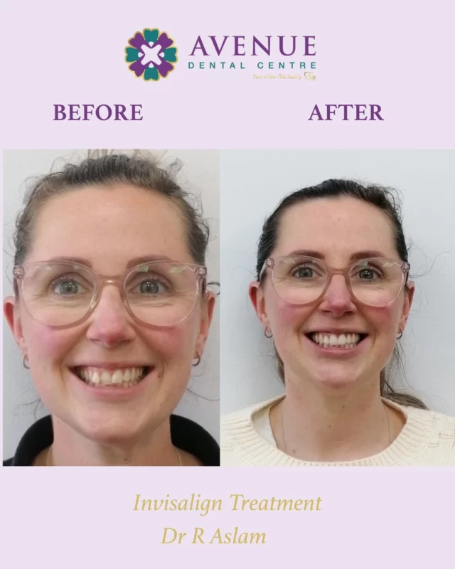This stunning smile transformation was made possible by Dr. Rabia’s expert Invisalign care – just look at the visible results! 😁💫

Ready for yours?
📆 Join us for our Invisalign Open Day – Saturday, 26th July
✔️ Free Smile Assessment
✔️ Save £696 on treatment
✔️ 0% Finance Options
✔️ Free Whitening Kit & Retainers

📲 Book now & start your smile journey with us!
🔗 https://audental.co.uk/avenue-dental-centre
📞 01942 676 336

#InvisalignBeforeAndAfter #SmileConfidence #DrRabiaSmiles #InvisalignOpenDay #ClearBraces #SmileTransformation #LeighDentist #StraightTeeth