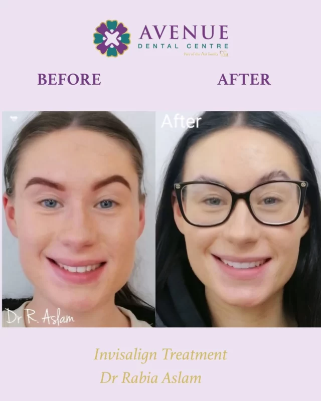 Dr. Rabia’s smile transformation speaks for itself – visible results with Invisalign and a confident new smile to match! 😁💫

Ready for yours?
📆 Join us for our Invisalign Open Day – Saturday, 26th July
✔️ Free Smile Assessment
✔️ Save £696 on treatment
✔️ 0% Finance Options
✔️ Free Whitening Kit & Retainers

📲 Book now & start your smile journey with us!
🔗 https://audental.co.uk/avenue-dental-centre
📞 01942 676 336

#InvisalignBeforeAndAfter #SmileConfidence #DrRabiaSmiles #InvisalignOpenDay #ClearBraces #SmileTransformation #LeighDentist #StraightTeeth