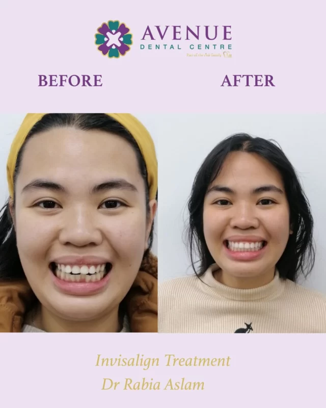 Struggling with gaps, crowded, or crooked teeth — but not a fan of metal braces? 🦷

✨ Clear aligners are a discreet, comfortable solution that can transform your smile with ease.

See the amazing results our patients have achieved — and start your own smile journey today!

📲 Book your consultation now .

#Invisalign #ClearAligners #SmileTransformation #CrookedTeeth #GappedTeeth #InvisibleBraces #AvenueDentalCente #ConfidentSmile