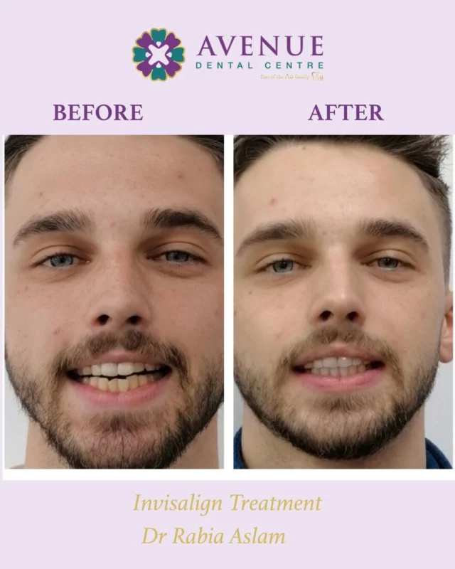 Dr. Rabia’s smile transformation speaks for itself – visible results with Invisalign and a confident new smile to match! 😁💫

📲 Book now & start your smile journey with us!
🔗 https://audental.co.uk/avenue-dental-centre
📞 01942 676 336

#InvisalignBeforeAndAfter #SmileConfidence #DrRabiaSmiles #InvisalignOpenDay #ClearBraces #SmileTransformation #LeighDentist #StraightTeeth