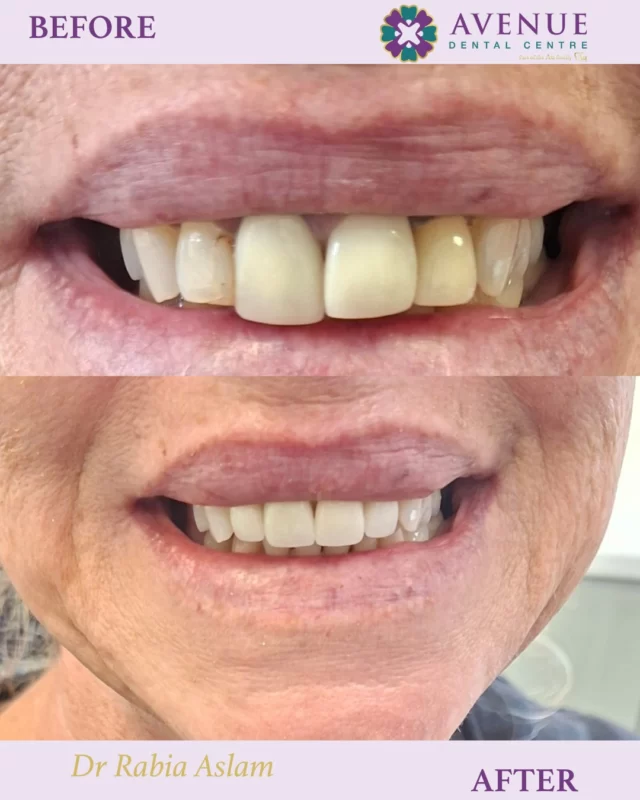 Old porcelain crowns replaced with natural-looking Emax crowns by Dr. Rabia Aslam 🦷💎
The transformation speaks for itself!

👉 Swipe to see the patient’s lovely review of their experience.

#EmaxCrowns #AvenueDentalCentre #DentalPracticeLeigh