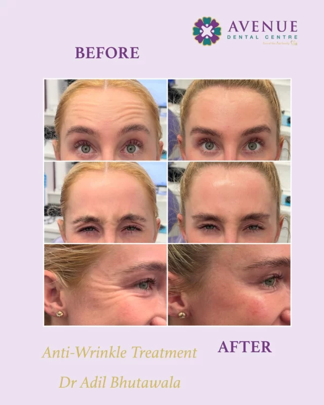 Experience the subtle, natural results of facial aesthetic treatments by Dr. Adil. Look refreshed, feel confident! 

#FacialAesthetics #BeforeAndAfter #NaturalResults