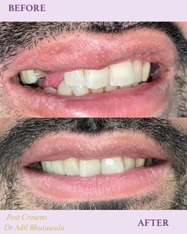 Before & After Smile Transformation
#DentalCrowns #SmileTransformation #BeforeAndAfter #DrAdilBhutawala