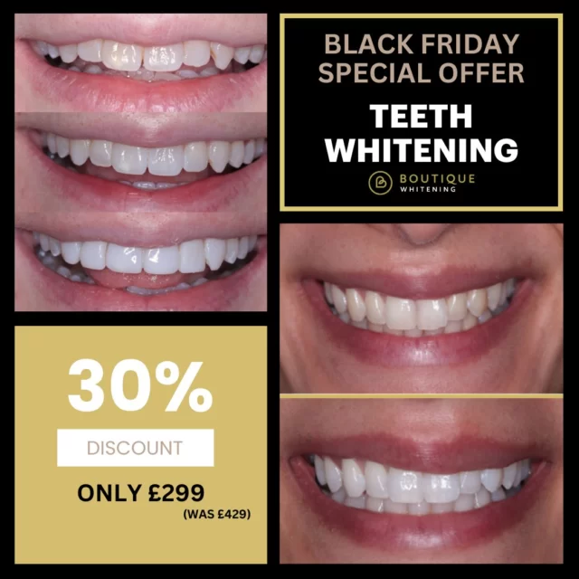 30% Off Teeth Whitening (Now just £299, was £429).
Secure your exclusive Black Friday dental deals today. Transform your smile and save big!

Don’t miss out — book your appointment today!
https://audental.co.uk/beach-road-dental or call us 01606 75180
#BlackFriday #DentalOffers #SmileMakeover #Invisalign #CompositeBonding #TeethWhitening