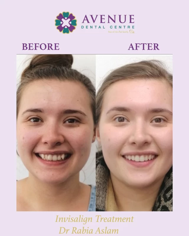 🎉 Black Friday Offer! 🎉

Look at this amazing smile transformation achieved with Invisalign by Dr. Rabia!
If you’re struggling with crooked teeth, an overbite, underbite, or spacing concerns — now is the perfect time to start.

✨ Save over £1,500 on our Invisalign package, including:

FREE consultation

FREE whitening

FREE retainers

Hurry, offer ends November 30th! Book your consultation now and transform your smile.
🔗 https://loom.ly/1bZDeNY
📞 01942 676 336

#Invisalign #ClearAligners #BeforeAndAfter #ConfidentSmiles #invisiblebraces