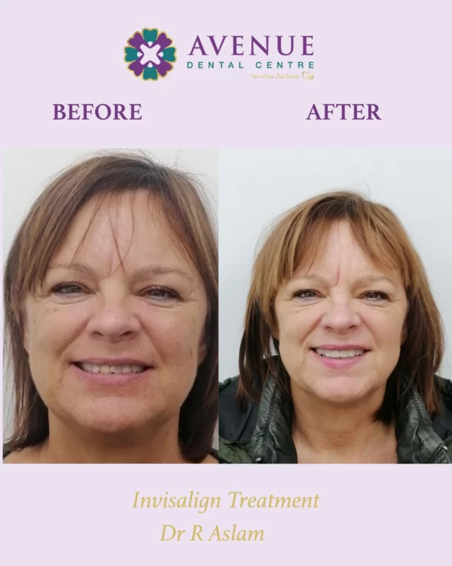 Another amazing smile transformation by Dr. Rabia with Invisalign treatment!
📅 Book your consultation now
💳 0% finance option available
🔗 https://audental.co.uk/avenue-dental-centre

📞 01942 676 336

#Invisalign #ClearAligners #BeforeAndAfter #ConfidentSmiles #invisiblebraces #Leigh