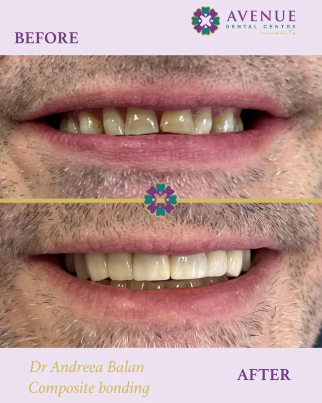 Look at this stunning before-and-after achieved with composite bonding by Dr. Andreea Balan. From chipped and uneven teeth to a flawless, natural-looking smile.

📲 Book now & start your smile journey with us!
🔗 https://audental.co.uk/avenue-dental-centre
📞 01942 676 336

#SmileMakeover #CompositeBonding #BeforeAndAfter #DrAndreeaBalan #AvenueDentalCentre #Leigh