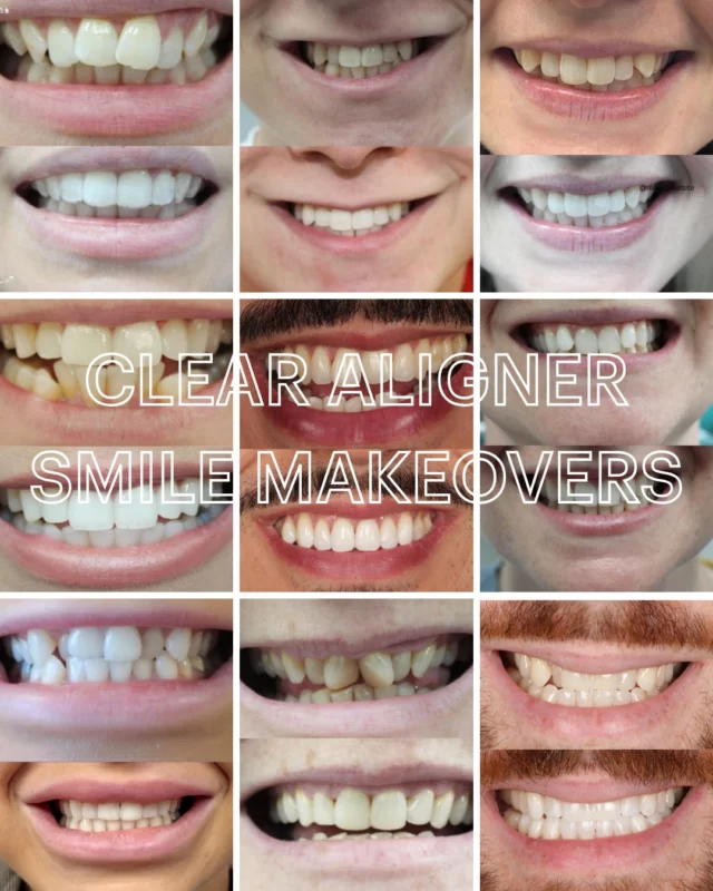 Clear Aligner Special Offer
Starting from £3,045, your package includes a FREE consultation, teeth whitening, and retainers.

📅 Available 1–31 March 2026
💜 Reserve your spot today with just a £30 deposit!

Transform your smile and boost your confidence.

🔗 Book online: https://audental.co.uk/locations/

📞 Call us: 0161 515 8113

#32Co #ClearAligners #SmileTransformation #TeethStraightening #SpecialOffer