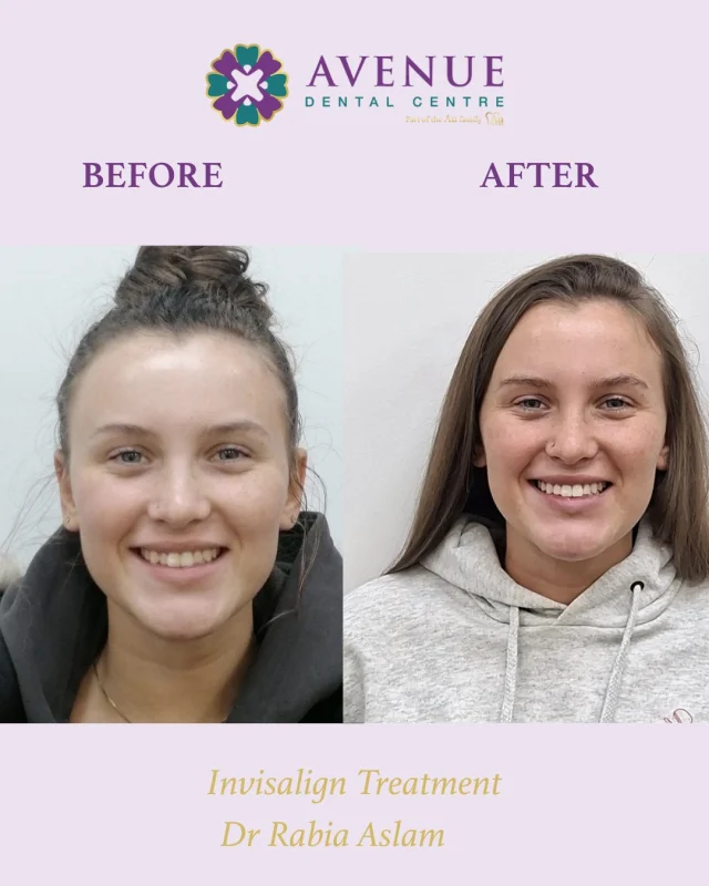 Smile transformation with clear aligners by Dr Rabia Aslam ✨ Straighter, healthier, more confident smiles.

📲 Book now & start your smile journey with us!
🔗 https://audental.co.uk/avenue-dental-centre
📞 01942 676 336

#BeforeAndAfter #SmileConfidence #DrRabiaSmiles #ClearBraces #SmileTransformation #LeighDentist #StraightTeeth