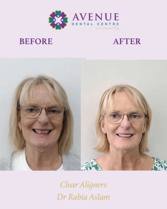 ✨ A smile that speaks for itself. This is what Clear Aligners can do — and it's never too late to love your smile.
💜 Treatment by Dr. Rabia Aslam

📩 DM us to book your consultation or book your consultation  online https://audental.co.uk/avenue-dental-centre/
#ClearAligners #SmileTransformation #BeforeAndAfter #AvenueDentalCentreLeigh