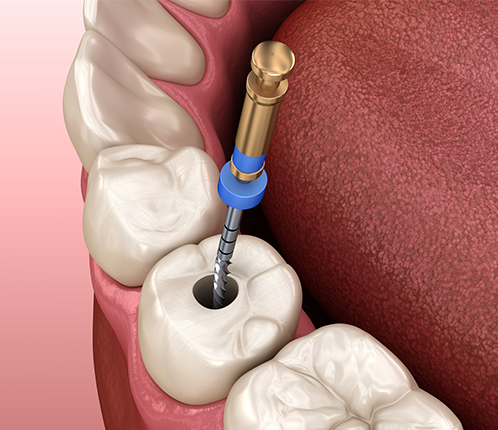Treatment - Park Lane Dental Centre